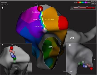 Local impedance and contact force guidance to predict successful cavotricuspid isthmus ablation with a zero-fluoroscopy approach